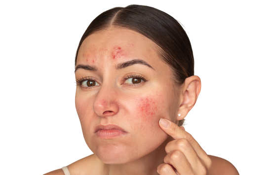 A woman with moderate acne on her face, looking at her skin while pointing to a spot on her cheek. 